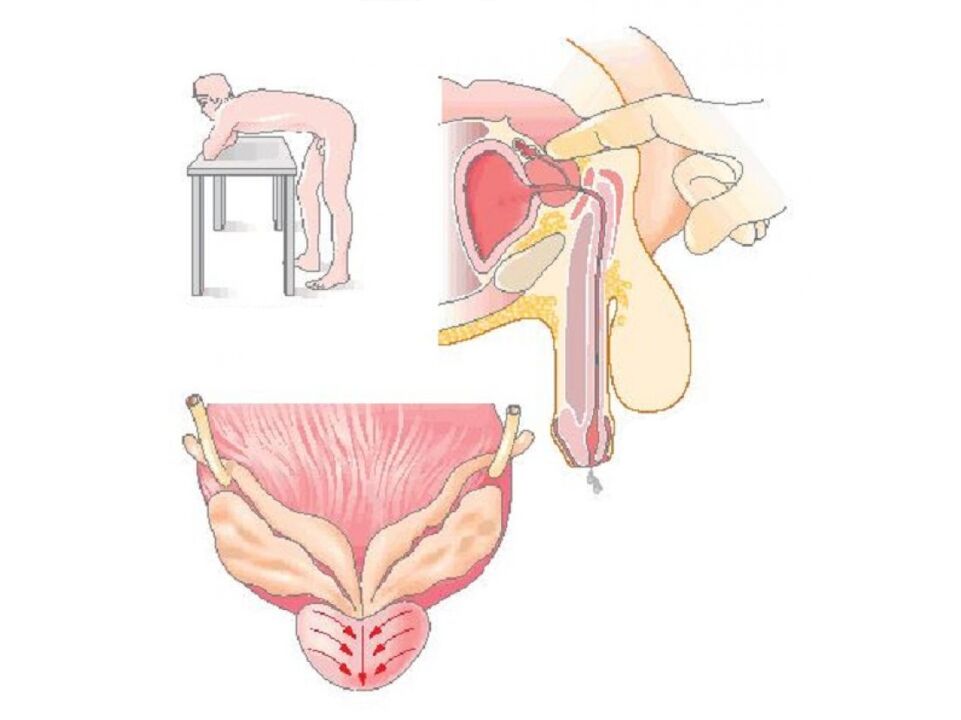 Technique de massage de la prostate par un médecin pour réaliser une analyse de la sécrétion